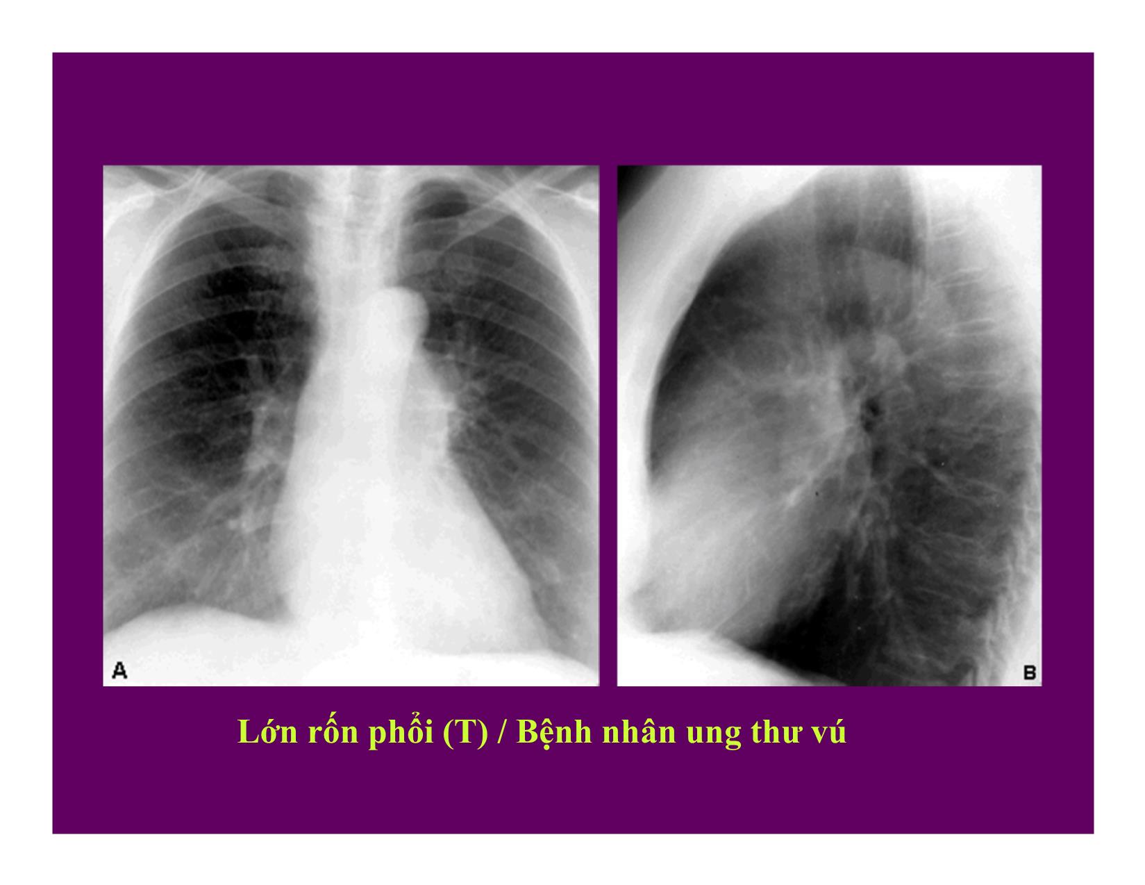Bài giảng Hình ảnh CT bệnh lý phổi trang 3