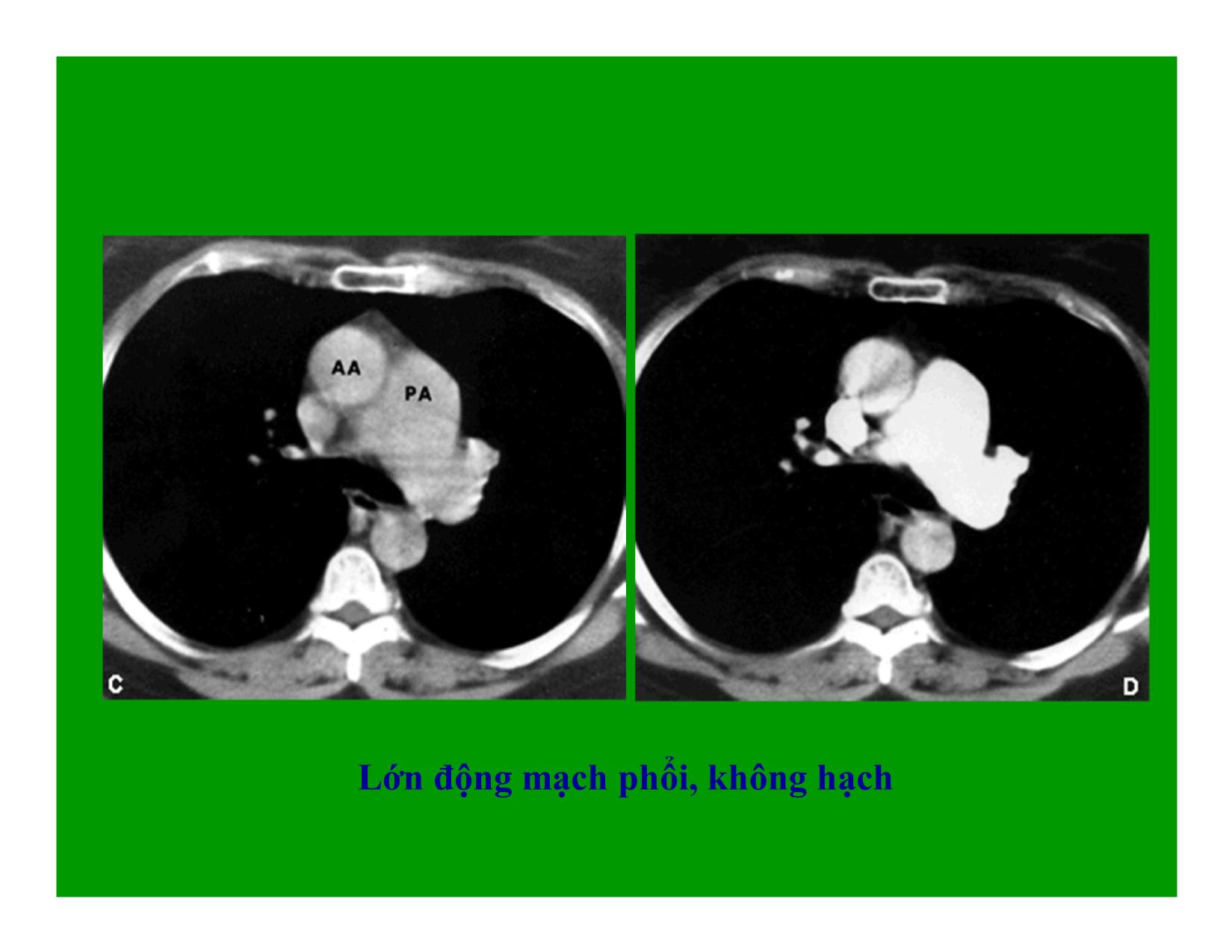 Bài giảng Hình ảnh CT bệnh lý phổi trang 4