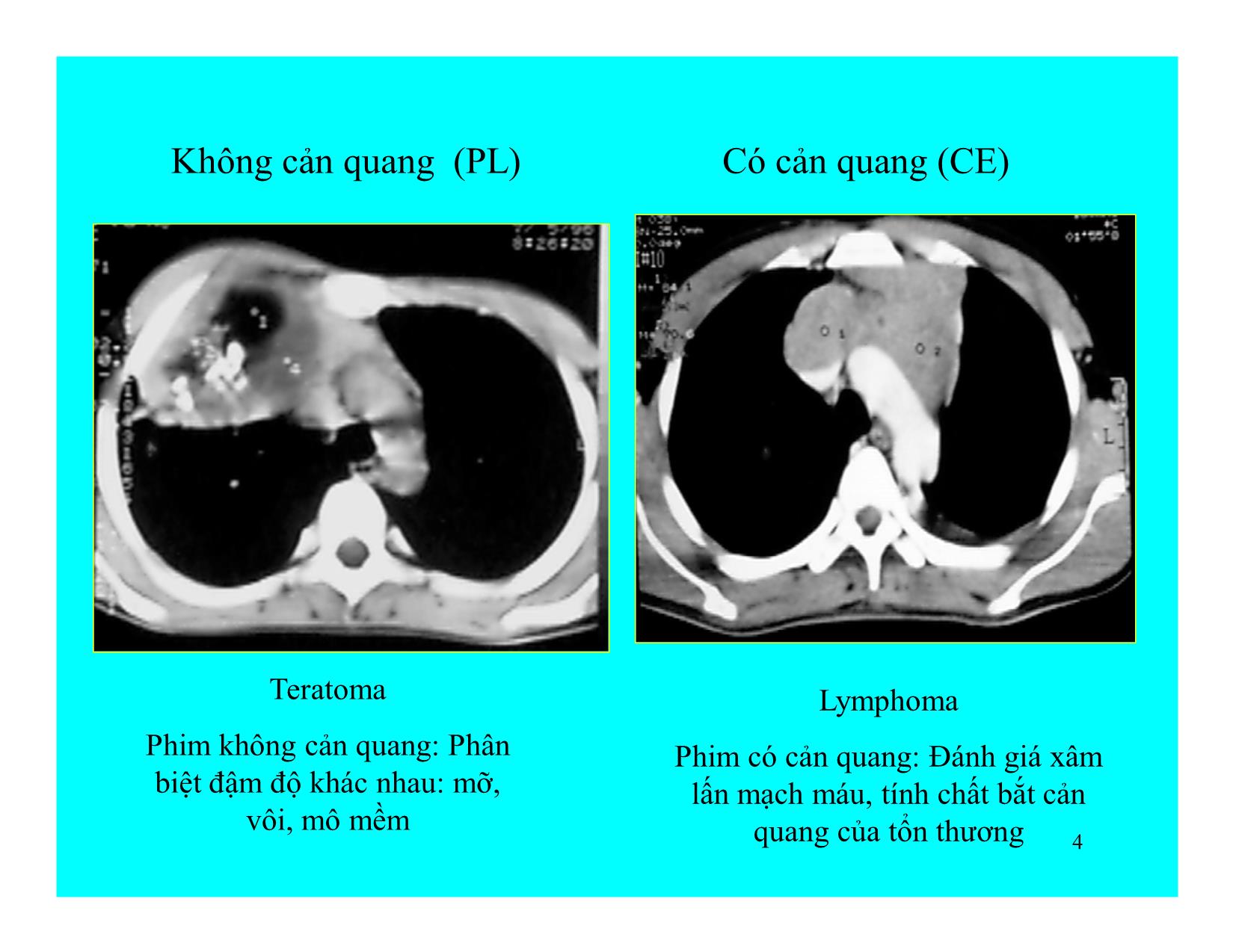 Bài giảng Hình ảnh CT ngực trang 4