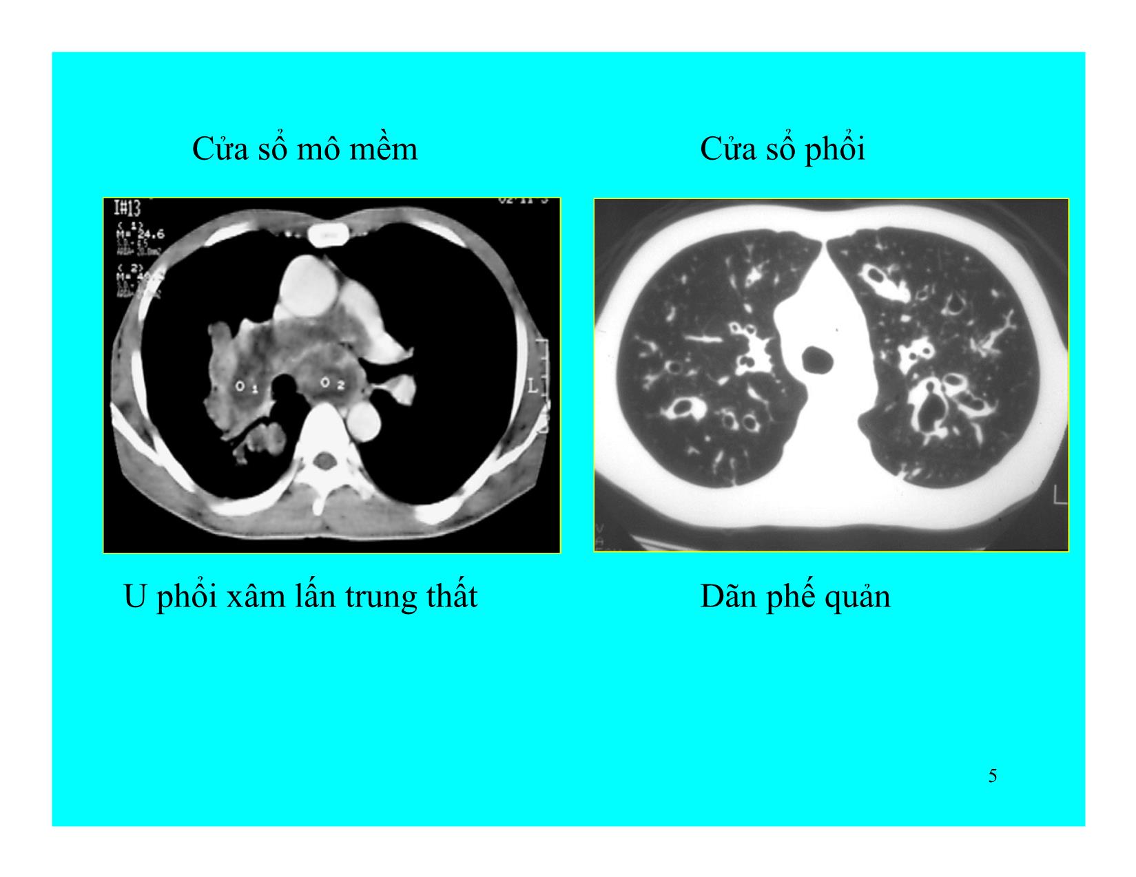Bài giảng Hình ảnh CT ngực trang 5