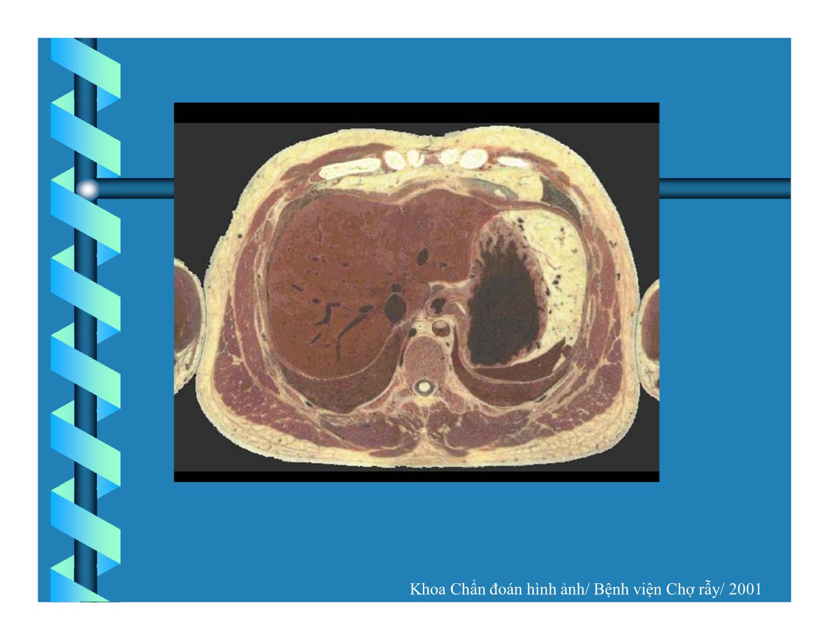 Bài giảng Hình ảnh giải phẫu CT bụng và bệnh lý gan trên CT trang 5